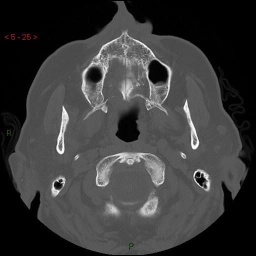 Bisphosphonate-related osteonecrosis of the jaw (Radiopaedia 54147-60329 Axial bone window 19).jpg