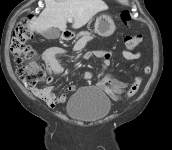 File:Bladder papillary urothelial carcinoma (Radiopaedia 48119-52951 C 25).png