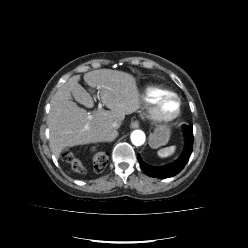File:Bladder tumor detected on trauma CT (Radiopaedia 51809-57609 A 78).jpg