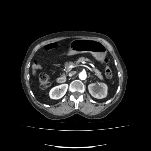File:Bladder tumor detected on trauma CT (Radiopaedia 51809-57609 A 97).jpg