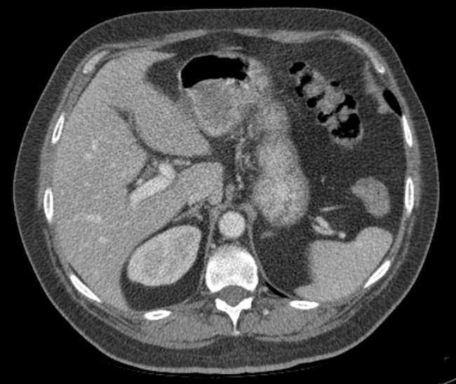 Bleeding duodenal ulcer and adenomyomatosis of gallbladder (Radiopaedia 61834-69861 A 28).jpg