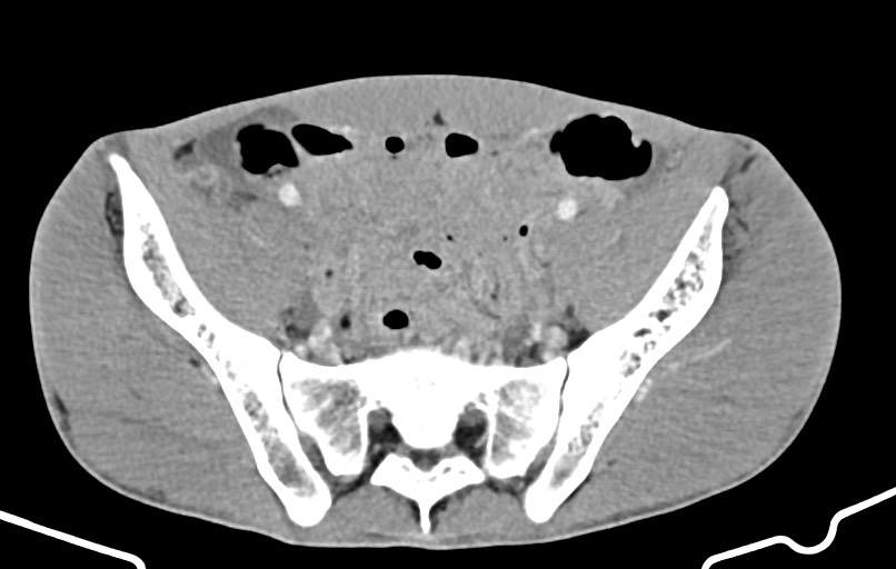 Blunt injury to the small bowel (Radiopaedia 74953-85987 A 153).jpg