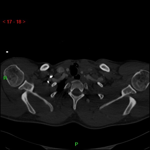 Blunt thoracic trauma (Radiopaedia 73454-84221 Axial bone window 8).jpg