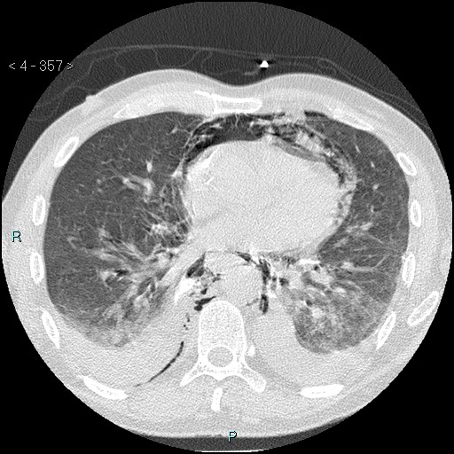File:Boerhaave syndrome (Radiopaedia 27683-27897 lung window 57).jpg