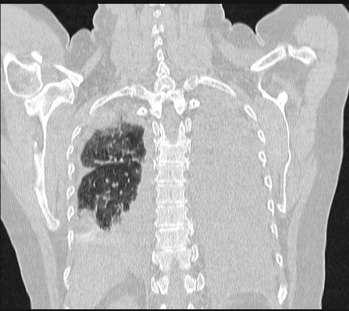 Boerhaave syndrome (Radiopaedia 45644-49799 Coronal lung window 54).jpg