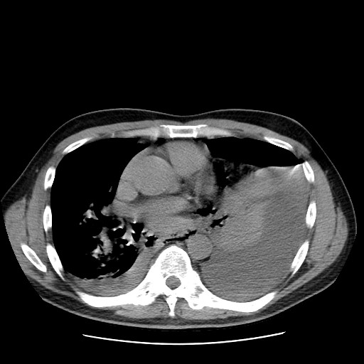 Boerhaave syndrome (Radiopaedia 59796-67310 Axial liver window 35).jpg