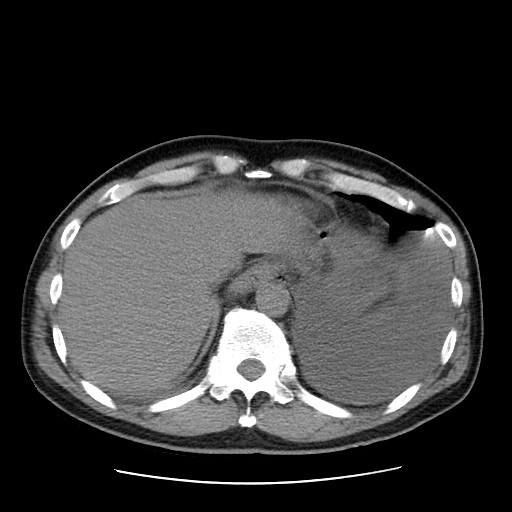 Boerhaave syndrome (Radiopaedia 59796-67310 Axial liver window 53).jpg