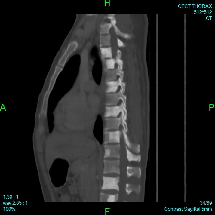 Bone metastases from lung carcinoma (Radiopaedia 54703-60937 Sagittal bone window 34).jpg