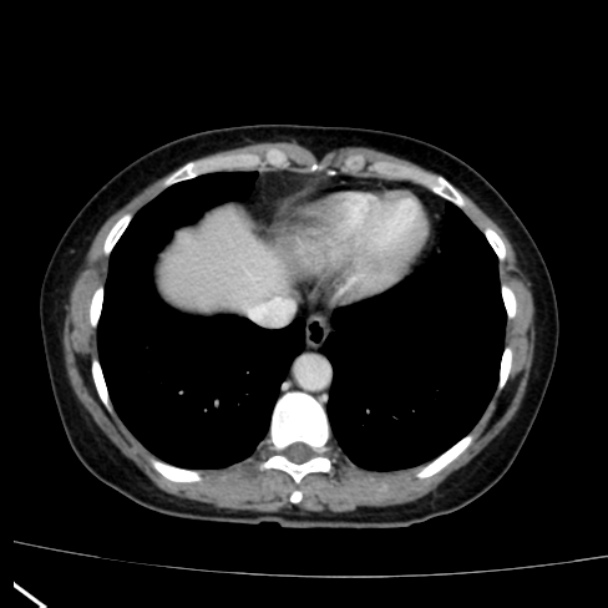 Bosniak renal cyst - type I (Radiopaedia 27479-27675 C 5).jpg