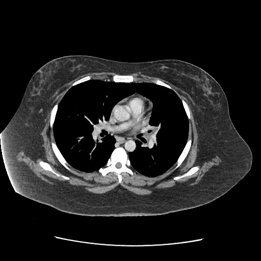 Bowel and splenic infarcts in acute lymphocytic leukemia (Radiopaedia 61055-68915 A 1).jpg