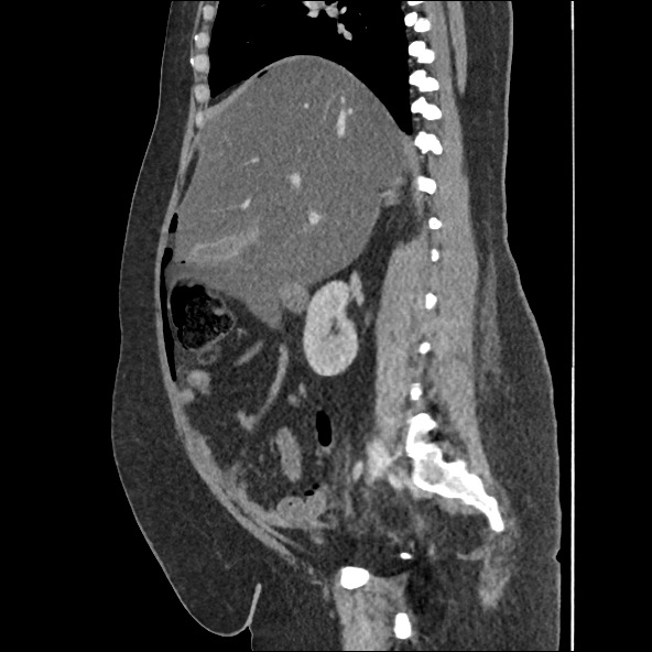 Bowel and splenic infarcts in acute lymphocytic leukemia (Radiopaedia 61055-68915 C 42).jpg