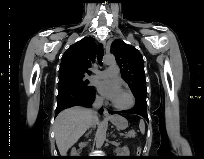 Brachial artery foreign body (Radiopaedia 54583-60820 Coronal non-contrast 28).jpg