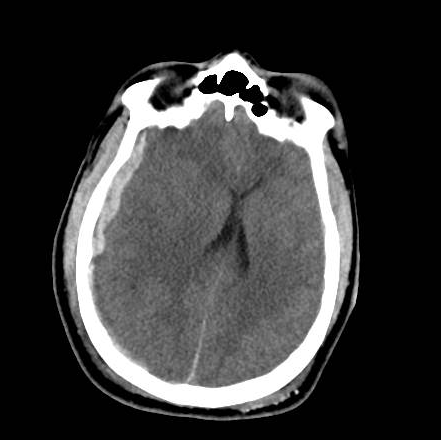 File:Brain death after motor vehicle collision (Radiopaedia 88470-105114 Axial 8).png