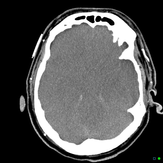 Brain death on MRI and CT angiography (Radiopaedia 42560-45841 B 32).jpg
