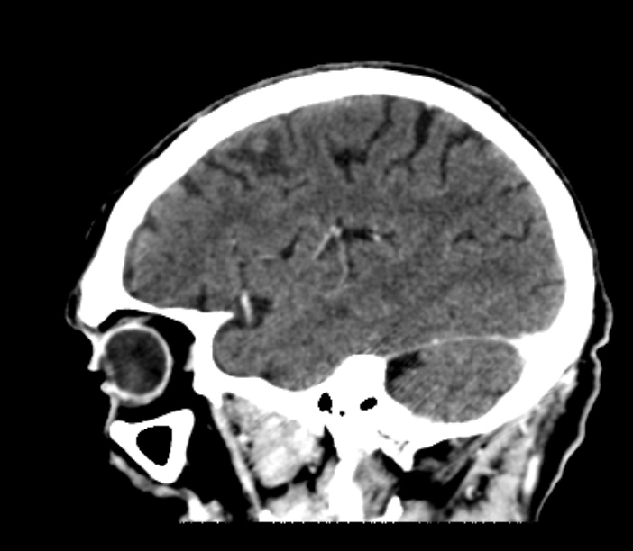 Brain metastases from lung cancer (Radiopaedia 27849-28092 Sagittal C+ delayed 46).jpg