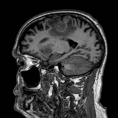 Brain metastases from lung cancer (Radiopaedia 83839-99028 Sagittal T1 84).jpg