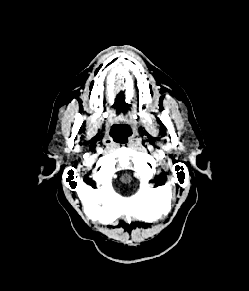 Brain metastasis (large cystic mass) (Radiopaedia 47497-52106 Axial C+ 10).png
