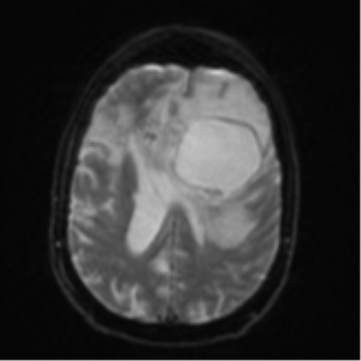 Brain metastasis (lung cancer) (Radiopaedia 48289-53179 Axial DWI 18).png
