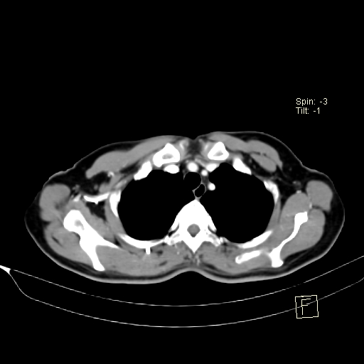 Brain metastasis as initial presentation of non-small cell lung cancer (Radiopaedia 65122-74127 A 9).jpg