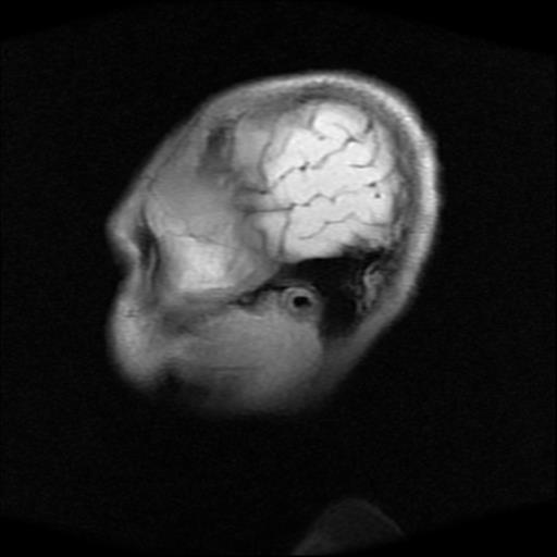 File:Brainstem glioma (Radiopaedia 30923-31624 Sagittal T1 17).jpg