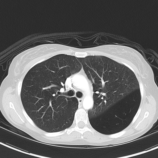 Bronchial atresia (Radiopaedia 73677-84470 Axial lung window 24).jpg
