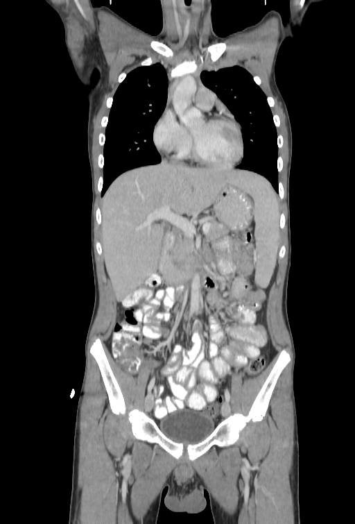 Bronchial carcinoid tumor (Radiopaedia 57187-64090 B 26).jpg