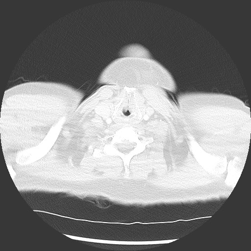 Bronchial carcinoid tumor (Radiopaedia 67377-76764 Axial lung window 3).jpg