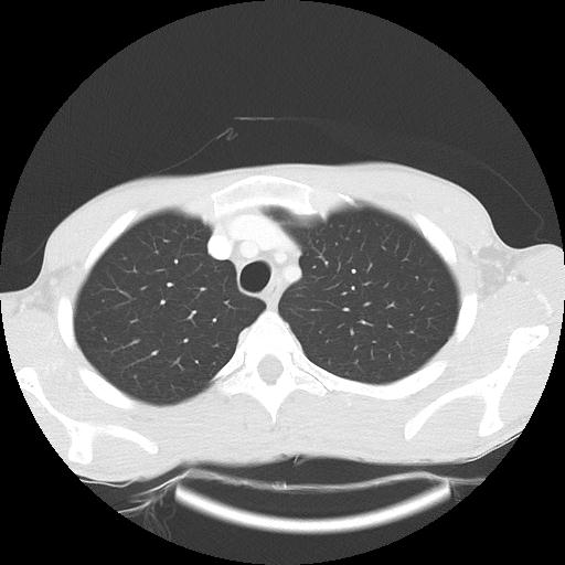 Bronchial carcinoid tumor causing right lower lobe collapse (Radiopaedia 83495-98594 Axial lung window 8).jpg