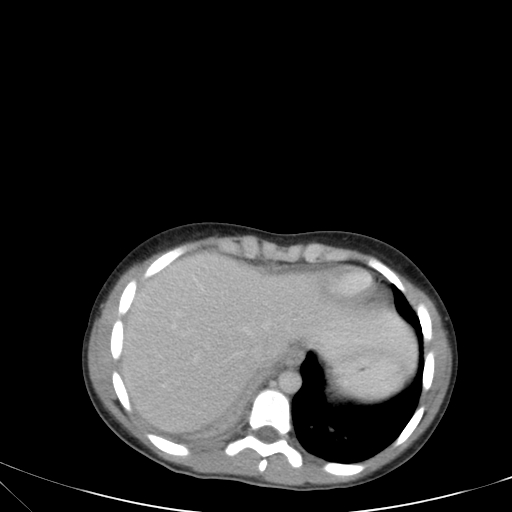 Bronchial mucoepidermoid carcinoma (Radiopaedia 57023-63895 Axial 83).jpg