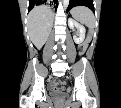 File:Bronchiectasis in Crohn disease (Radiopaedia 60311-67977 C 54).jpg