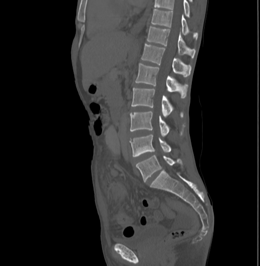 Bronchiectasis in Crohn disease (Radiopaedia 60311-67977 Sagittal bone window 127).jpg
