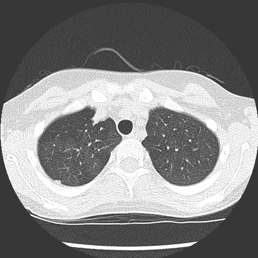 Bronchiolotis obliterans (Radiopaedia 73769-84575 Axial lung window 10).jpg