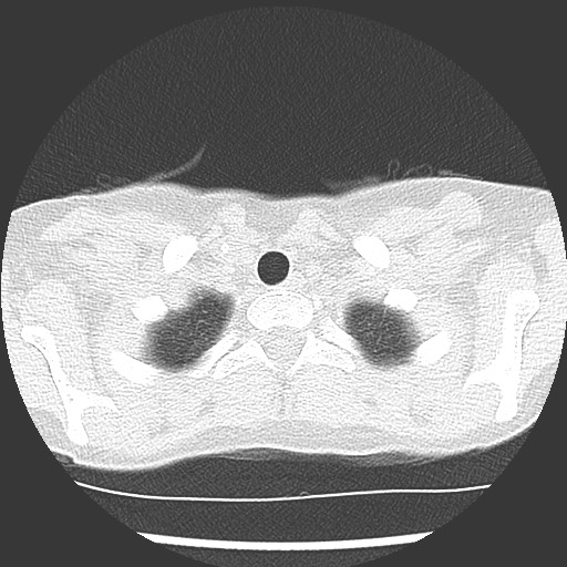 Bronchiolotis obliterans (Radiopaedia 73769-84575 Axial lung window 4).jpg