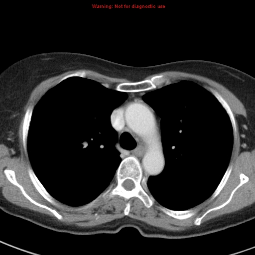 File:Bronchoalveolar carcinoma (BAC) (Radiopaedia 13436-13392 B 18).jpg