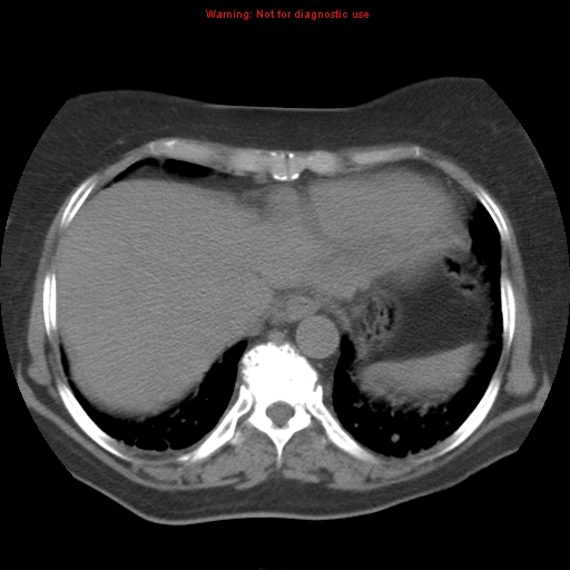 File:Bronchoalveolar carcinoma (Radiopaedia 13224-13233 Axial non-contrast 35).jpg