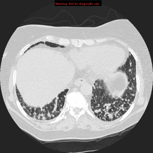 File:Bronchoalveolar carcinoma (Radiopaedia 13224-13233 B 8).jpg