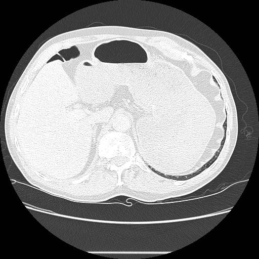 File:Bronchocele (Radiopaedia 17097-16795 Axial lung window 113).jpg