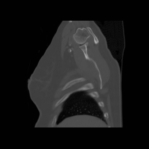Bronchogenic carcinoma (Radiopaedia 73497-84262 Sagittal bone window 28).jpg