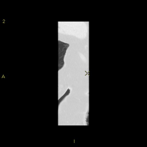 File:Bronchogenic carcinoma as an incidental finding (Radiopaedia 16453-16130 Sagittal lung window 1).jpg