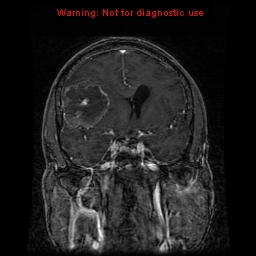 File:Bronchogenic carcinoma brain metastasis (Radiopaedia 9286-9969 Coronal T1 23).jpg