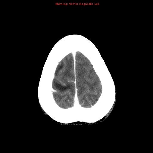 File:Bronchogenic carcinoma brain metastasis (Radiopaedia 9286-9970 B 26).jpg
