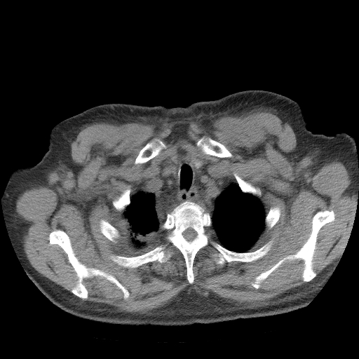 Bronchogenic carcinoma with metastatic lymphadenopathy (Radiopaedia 37671-39569 Axial non-contrast 7).jpg