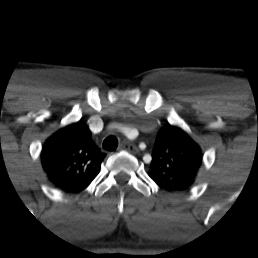 Buccal fat pad arteriovenous malformation (Radiopaedia 70936-81144 A 103).jpg
