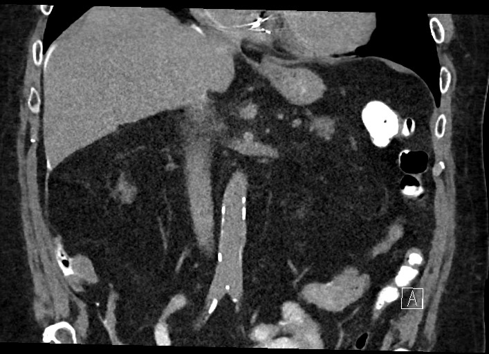 File:Buried bumper syndrome - gastrostomy tube (Radiopaedia 63843-72577 Coronal Inject 68).jpg