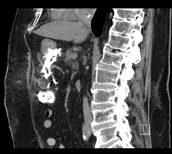 Buried bumper syndrome - gastrostomy tube (Radiopaedia 63843-72577 Sagittal Inject 64).jpg