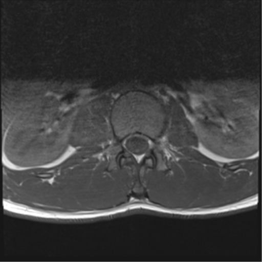 File:Burst fracture - T12 with conus compression (Radiopaedia 56825-63646 Axial T1 9).png