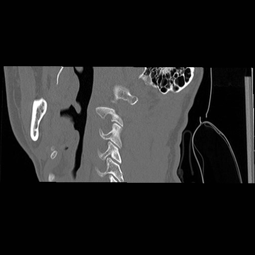 File:C1-C2 "subluxation" - normal cervical anatomy at maximum head rotation (Radiopaedia 42483-45607 C 53).jpg