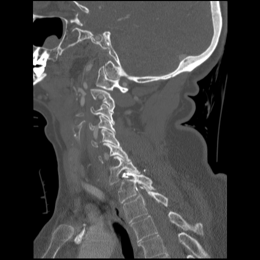 File:C1 anterior arch (plough) fracture - type 1 (Radiopaedia 76181-87720 Sagittal bone window 45).jpg
