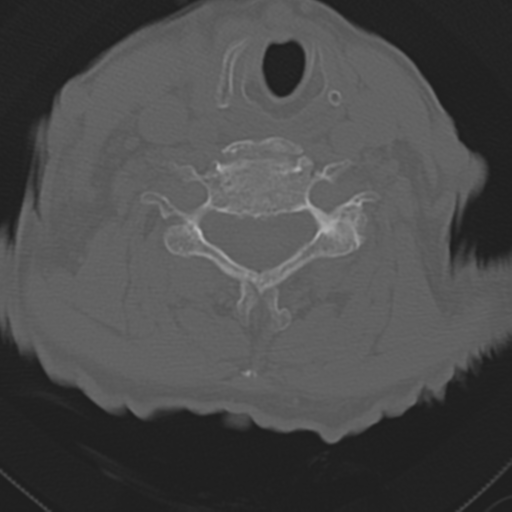 C2 fracture with vertebral artery dissection (Radiopaedia 37378-39199 Axial bone window 35).png