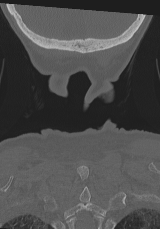 C2 fracture with vertebral artery dissection (Radiopaedia 37378-39199 Coronal bone window 60).png